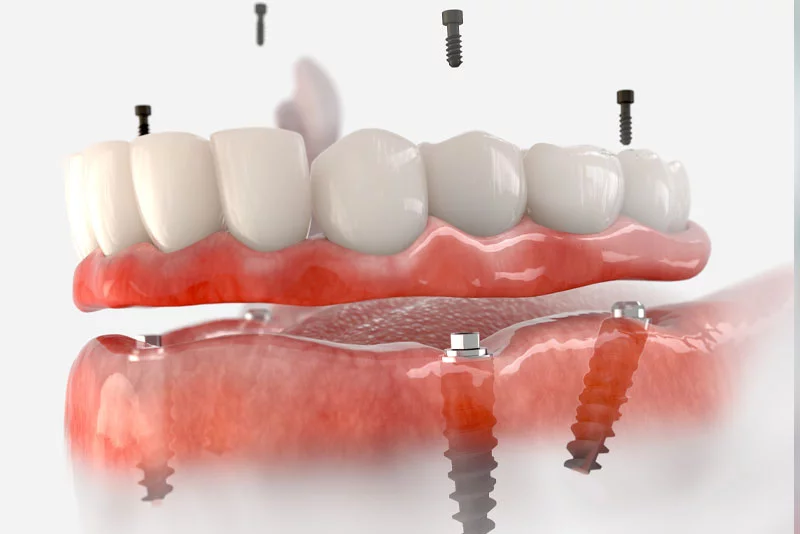 Full-arch implant prosthesis seated on multi-unit abutments