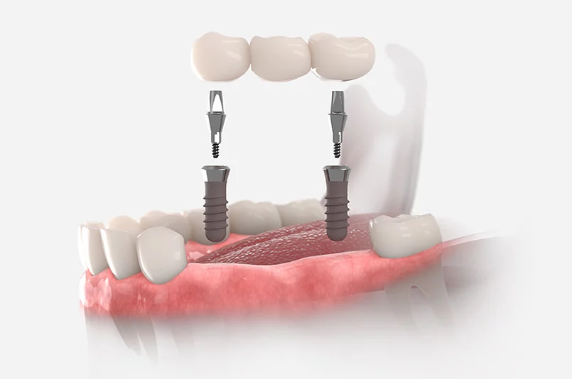 Three-unit implant bridge on two implants