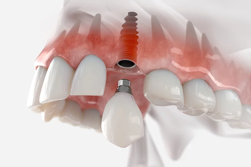 Single implant crown with custom abutment